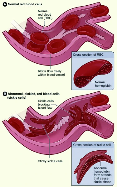Why Are Scientists Fighting Childhood Sickle Cell Disease? - Health