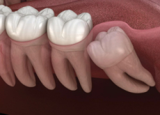 Do Wisdom Teeth Really Need to Be Removed? - Science